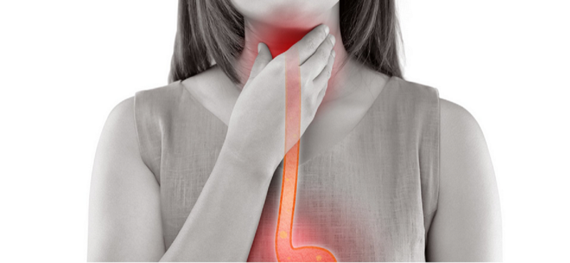 Medical illustration showing gastroesophageal reflux with esophagus and stomach anatomy